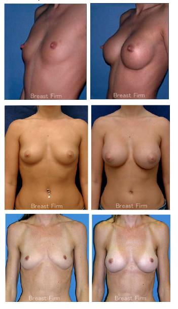 beforeore_after_breast