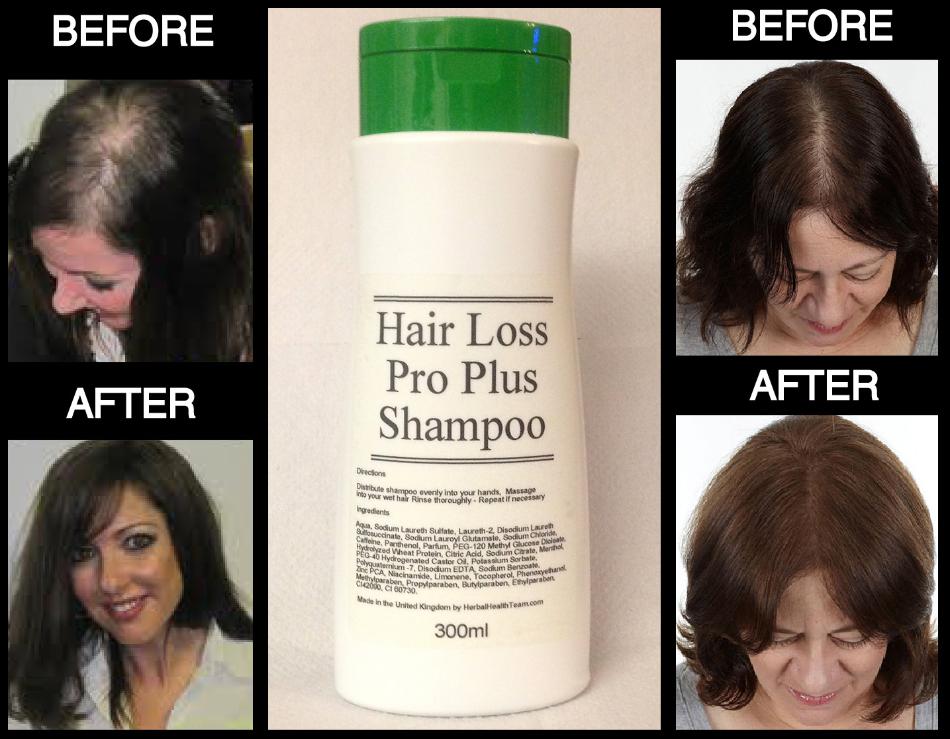 Best Hair loss shampoo