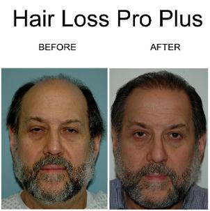 Hair_Loss_Pro_Plus_before_after