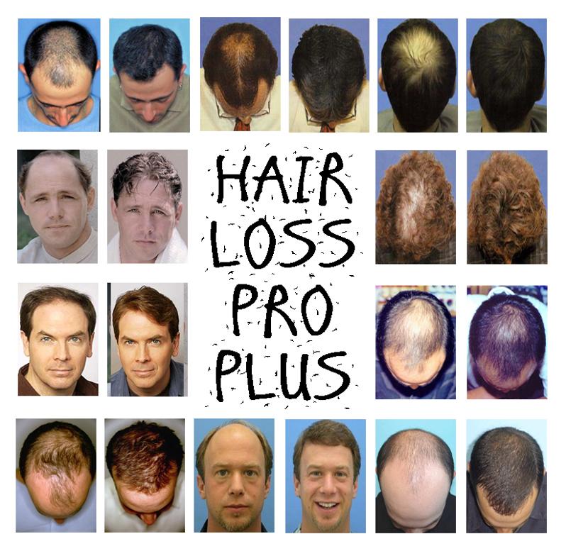 hair_loss_shampoo