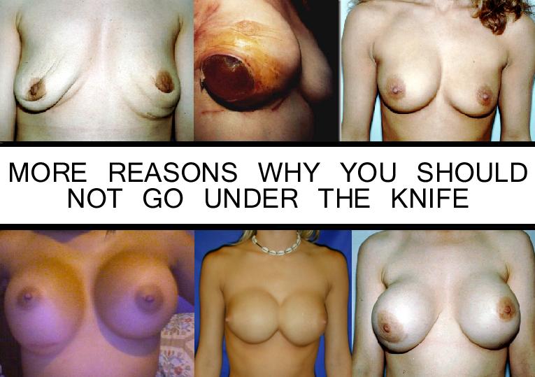 breast_implants_gone_wrong